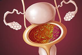 Bakteriaalne tsüstiidis naisel